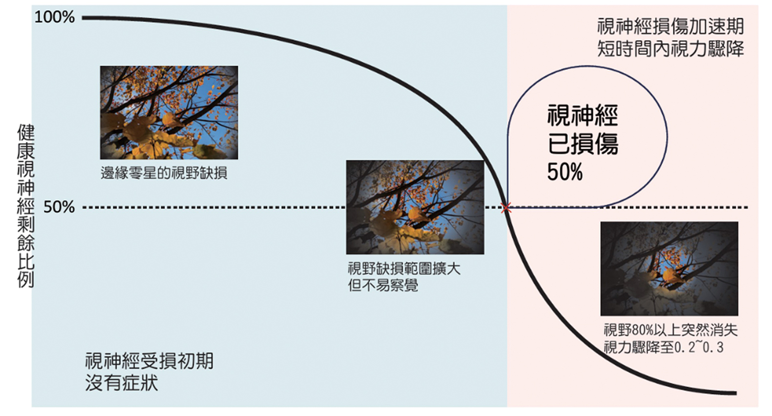 青光眼治療新選擇青光眼與微創眼內導流支架